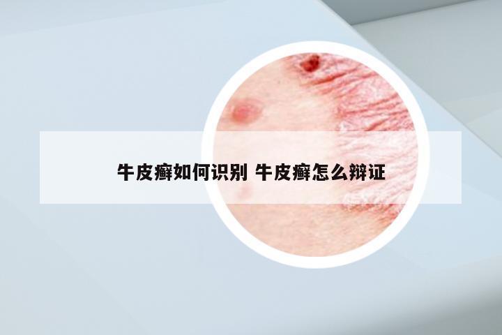 牛皮癣如何识别 牛皮癣怎么辩证