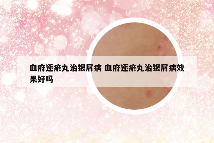 血府逐瘀丸治银屑病 血府逐瘀丸治银屑病效果好吗