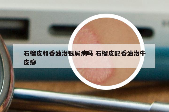 石榴皮和香油治银屑病吗 石榴皮配香油治牛皮癣