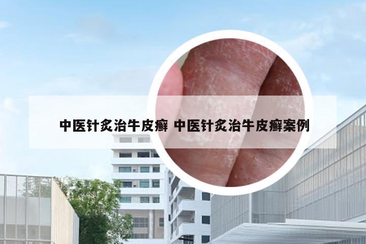 中医针炙治牛皮癣 中医针炙治牛皮癣案例