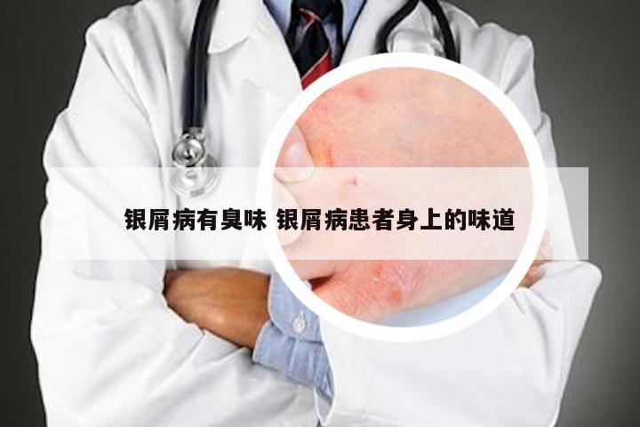 银屑病有臭味 银屑病患者身上的味道