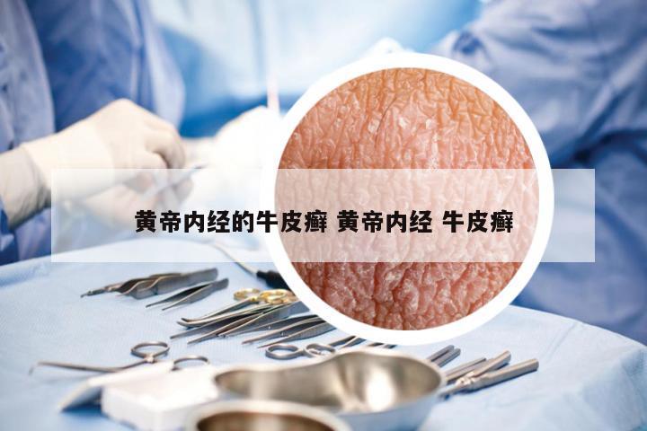 黄帝内经的牛皮癣 黄帝内经 牛皮癣