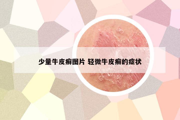 少量牛皮癣图片 轻微牛皮癣的症状