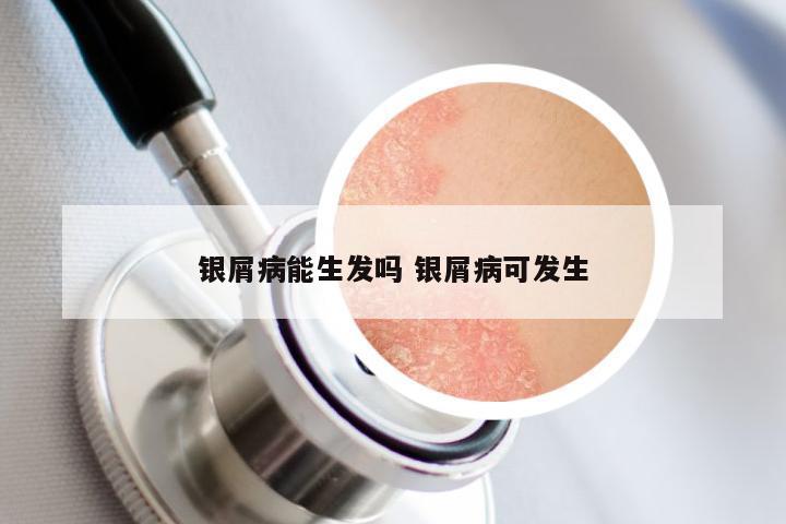 银屑病能生发吗 银屑病可发生