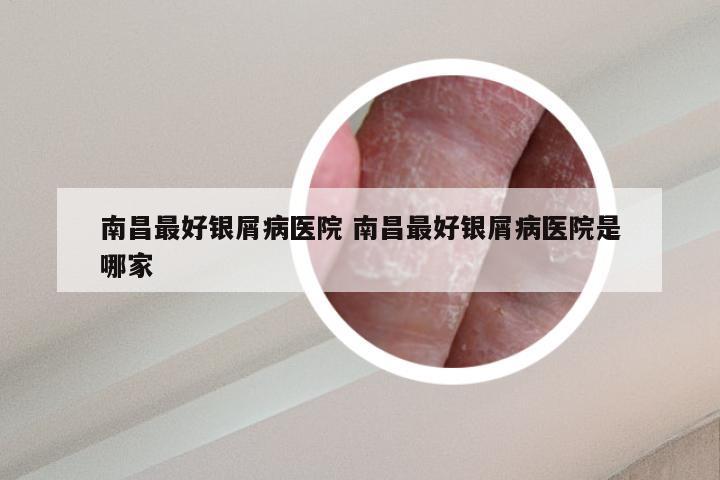 南昌最好银屑病医院 南昌最好银屑病医院是哪家