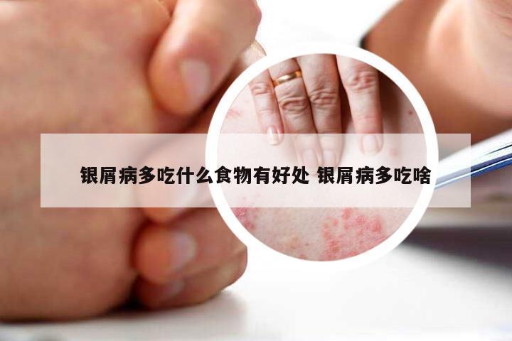 银屑病多吃什么食物有好处 银屑病多吃啥