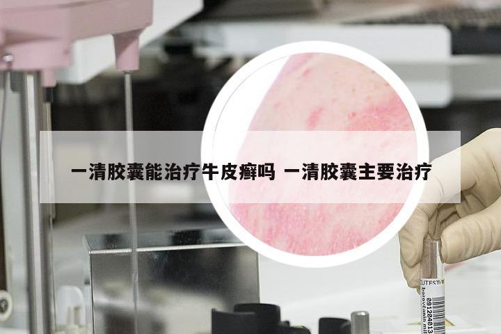 一清胶囊能治疗牛皮癣吗 一清胶囊主要治疗