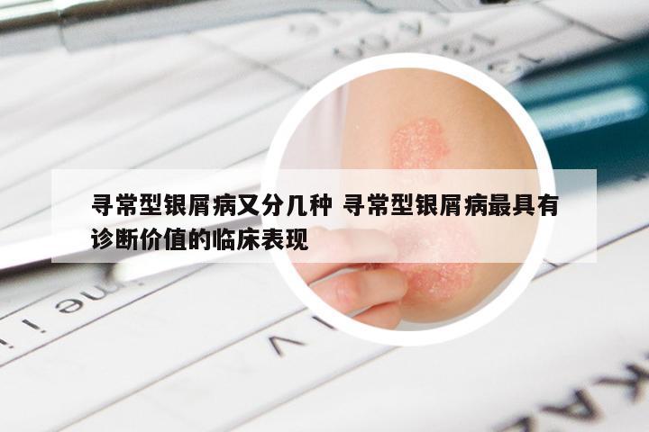 寻常型银屑病又分几种 寻常型银屑病最具有诊断价值的临床表现