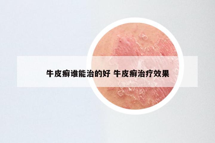 牛皮癣谁能治的好 牛皮癣治疗效果