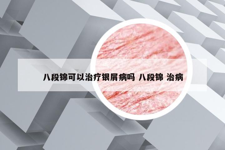 八段锦可以治疗银屑病吗 八段锦 治病