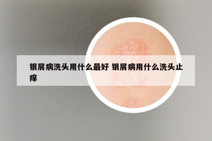 银屑病洗头用什么最好 银屑病用什么洗头止痒