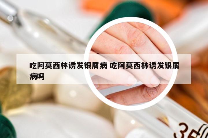 吃阿莫西林诱发银屑病 吃阿莫西林诱发银屑病吗