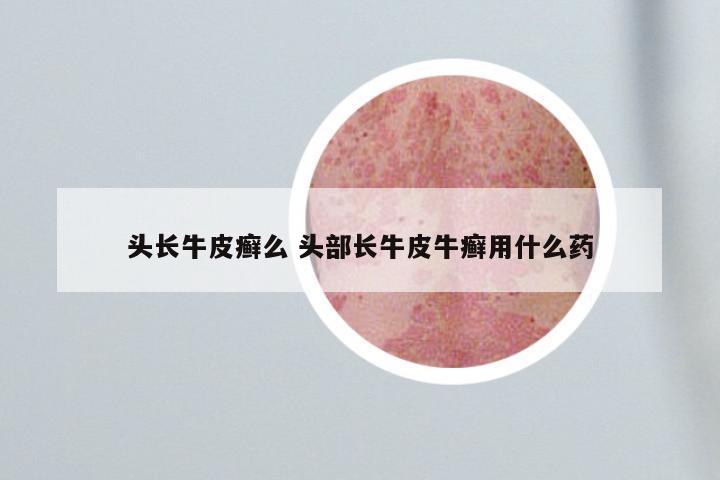 头长牛皮癣么 头部长牛皮牛癣用什么药