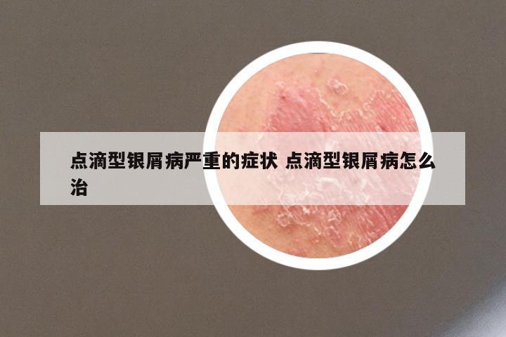 点滴型银屑病严重的症状 点滴型银屑病怎么治