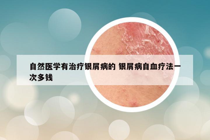 自然医学有治疗银屑病的 银屑病自血疗法一次多钱