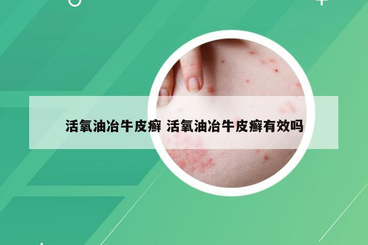 活氧油冶牛皮癣 活氧油冶牛皮癣有效吗