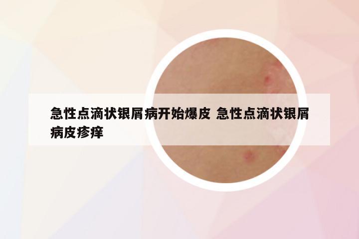 急性点滴状银屑病开始爆皮 急性点滴状银屑病皮疹痒