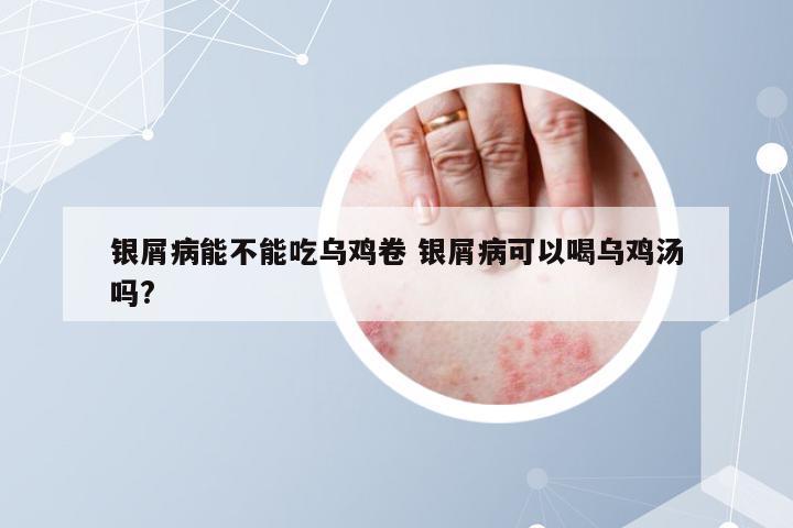 银屑病能不能吃乌鸡卷 银屑病可以喝乌鸡汤吗?