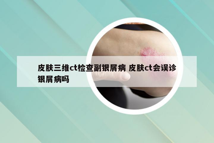 皮肤三维ct检查副银屑病 皮肤ct会误诊银屑病吗