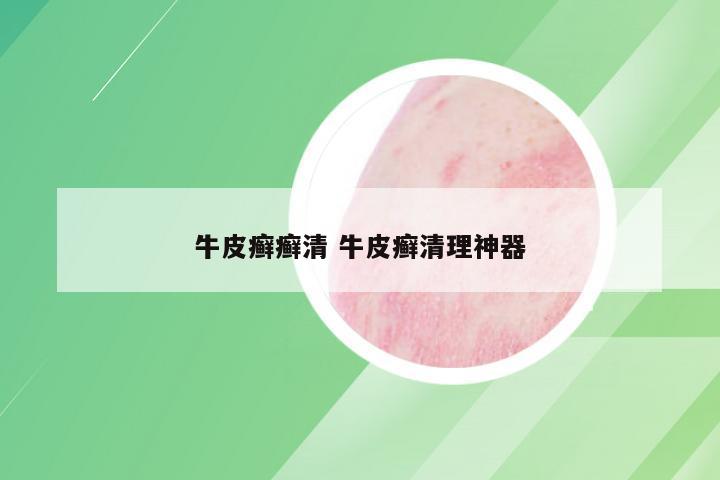 牛皮癣癣清 牛皮癣清理神器