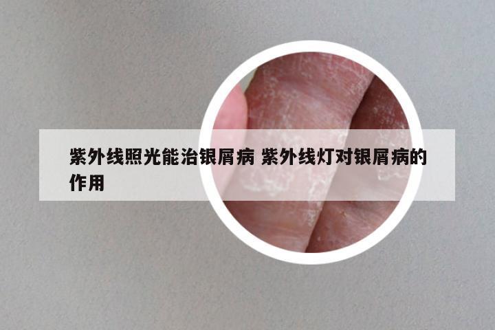 紫外线照光能治银屑病 紫外线灯对银屑病的作用