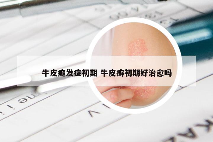 牛皮癣发症初期 牛皮癣初期好治愈吗
