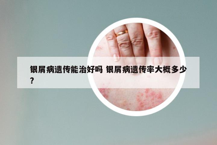 银屑病遗传能治好吗 银屑病遗传率大概多少?