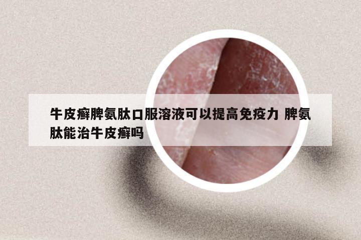 牛皮癣脾氨肽口服溶液可以提高免疫力 脾氨肽能治牛皮癣吗