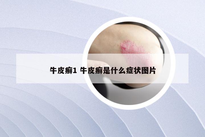 牛皮癣1 牛皮癣是什么症状图片