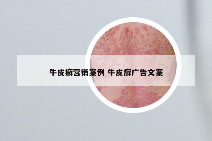 牛皮癣营销案例 牛皮癣广告文案