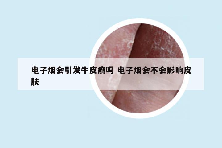 电子烟会引发牛皮癣吗 电子烟会不会影响皮肤