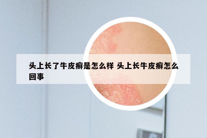 头上长了牛皮癣是怎么样 头上长牛皮癣怎么回事