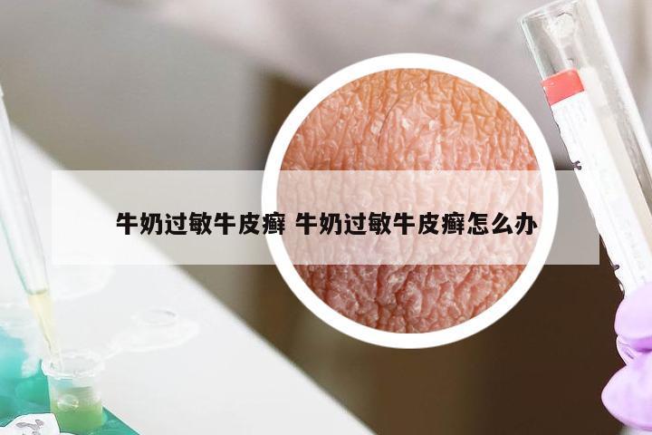 牛奶过敏牛皮癣 牛奶过敏牛皮癣怎么办