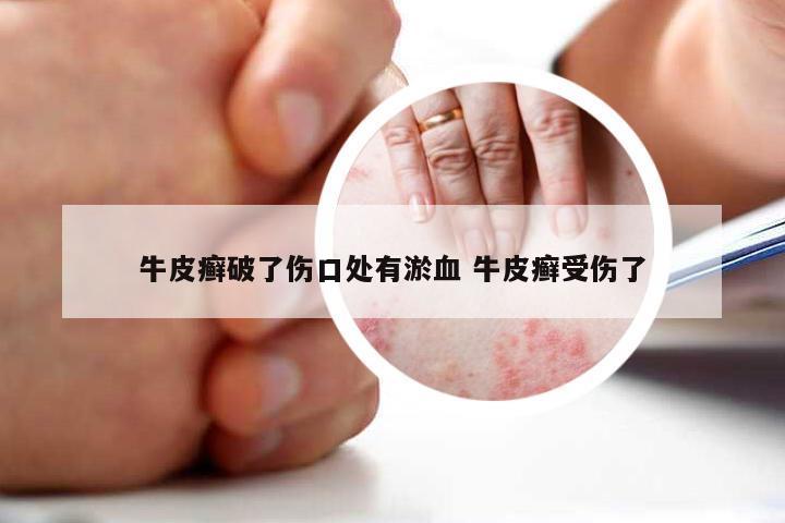 牛皮癣破了伤口处有淤血 牛皮癣受伤了