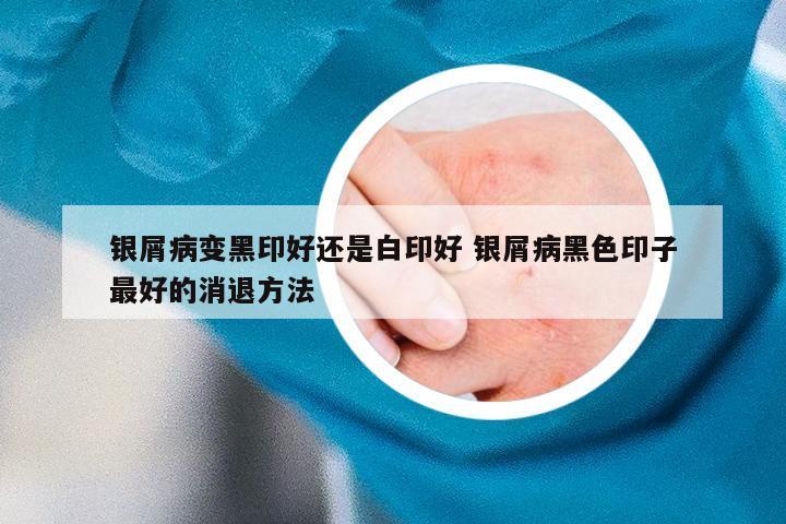 银屑病变黑印好还是白印好 银屑病黑色印子最好的消退方法