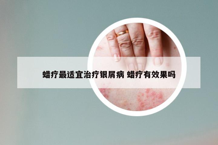 蜡疗最适宜治疗银屑病 蜡疗有效果吗