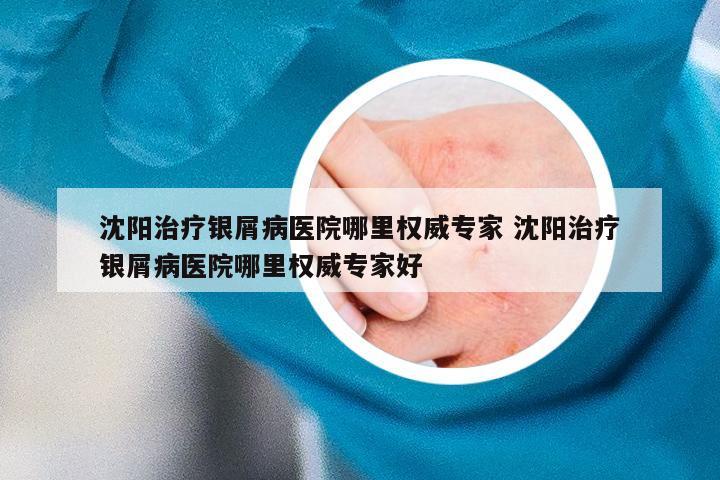 沈阳治疗银屑病医院哪里权威专家 沈阳治疗银屑病医院哪里权威专家好