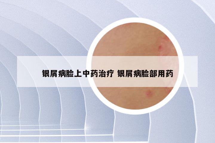 银屑病脸上中药治疗 银屑病脸部用药