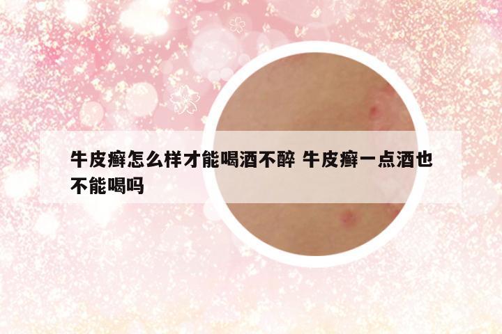 牛皮癣怎么样才能喝酒不醉 牛皮癣一点酒也不能喝吗