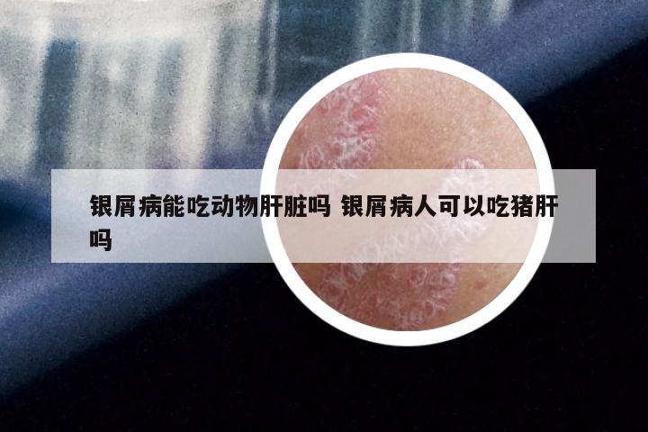 银屑病能吃动物肝脏吗 银屑病人可以吃猪肝吗