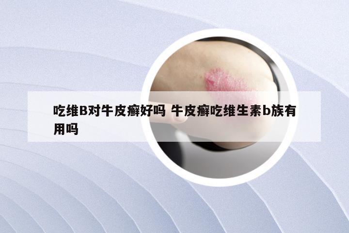 吃维B对牛皮癣好吗 牛皮癣吃维生素b族有用吗
