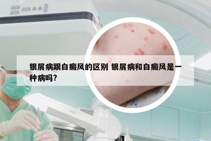 银屑病跟白癜风的区别 银屑病和白癜风是一种病吗?