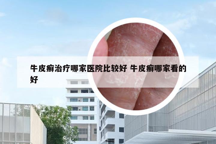 牛皮癣治疗哪家医院比较好 牛皮癣哪家看的好