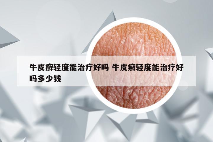 牛皮癣轻度能治疗好吗 牛皮癣轻度能治疗好吗多少钱