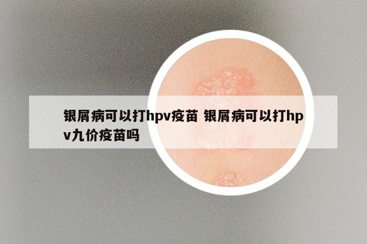 银屑病可以打hpv疫苗 银屑病可以打hpv九价疫苗吗