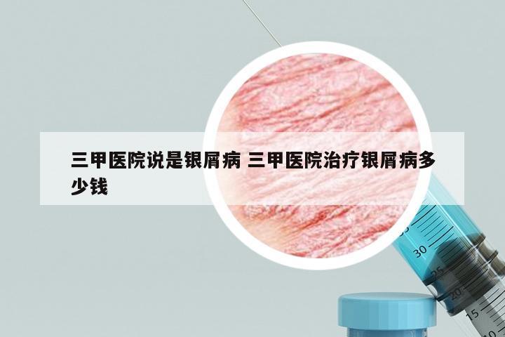 三甲医院说是银屑病 三甲医院治疗银屑病多少钱