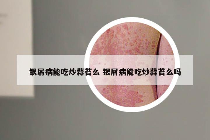 银屑病能吃炒蒜苔么 银屑病能吃炒蒜苔么吗