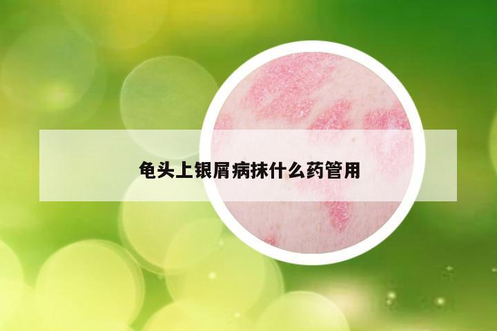 龟头上银屑病抹什么药管用