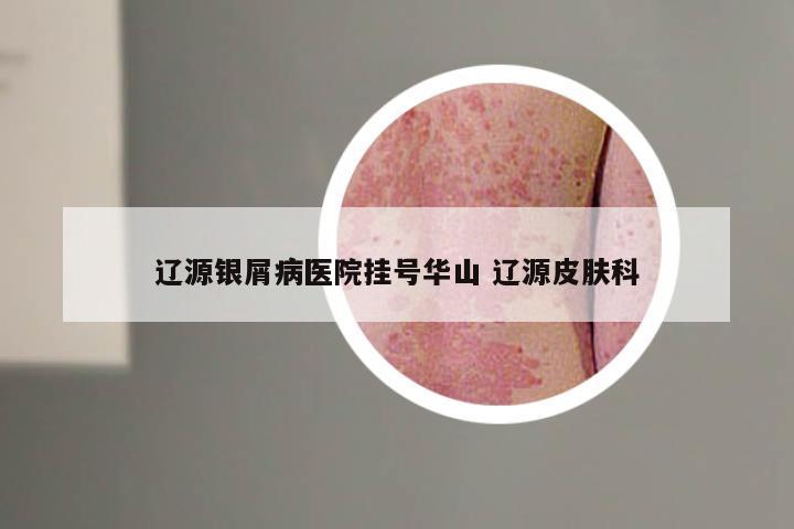辽源银屑病医院挂号华山 辽源皮肤科