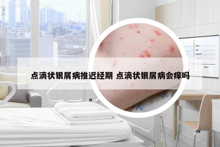 点滴状银屑病推迟经期 点滴状银屑病会痒吗